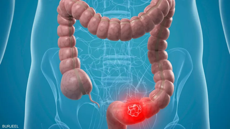 طبيب بريطاني يربط بين المكملات الغذائية وسرطان القولون