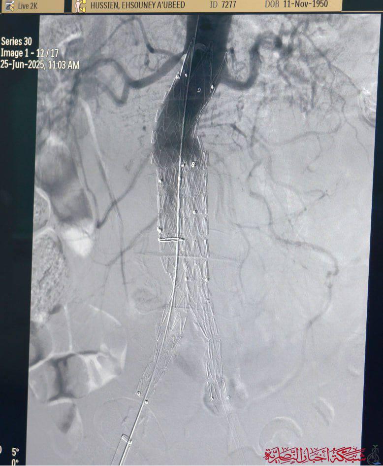 صورة من مقال: مستشفى الناصرية للقلب ينجح في أول عملية نوعية لإصلاح الشريان الأورطي دون تخدير عام