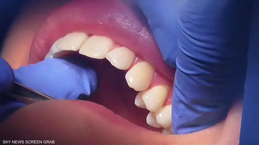 صورة من مقال: علماء يطورون هلاما لإصلاح الأسنان التالفة دون جراحة