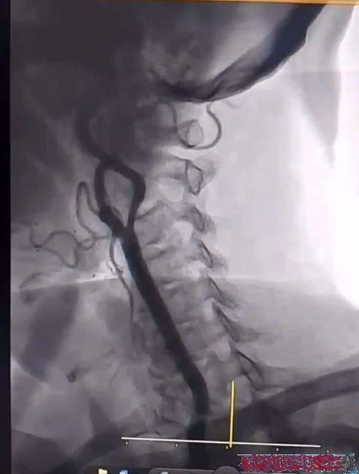 صورة من مقال: نجاح عمليتين نوعيتين في مستشفى الناصرية للقلب