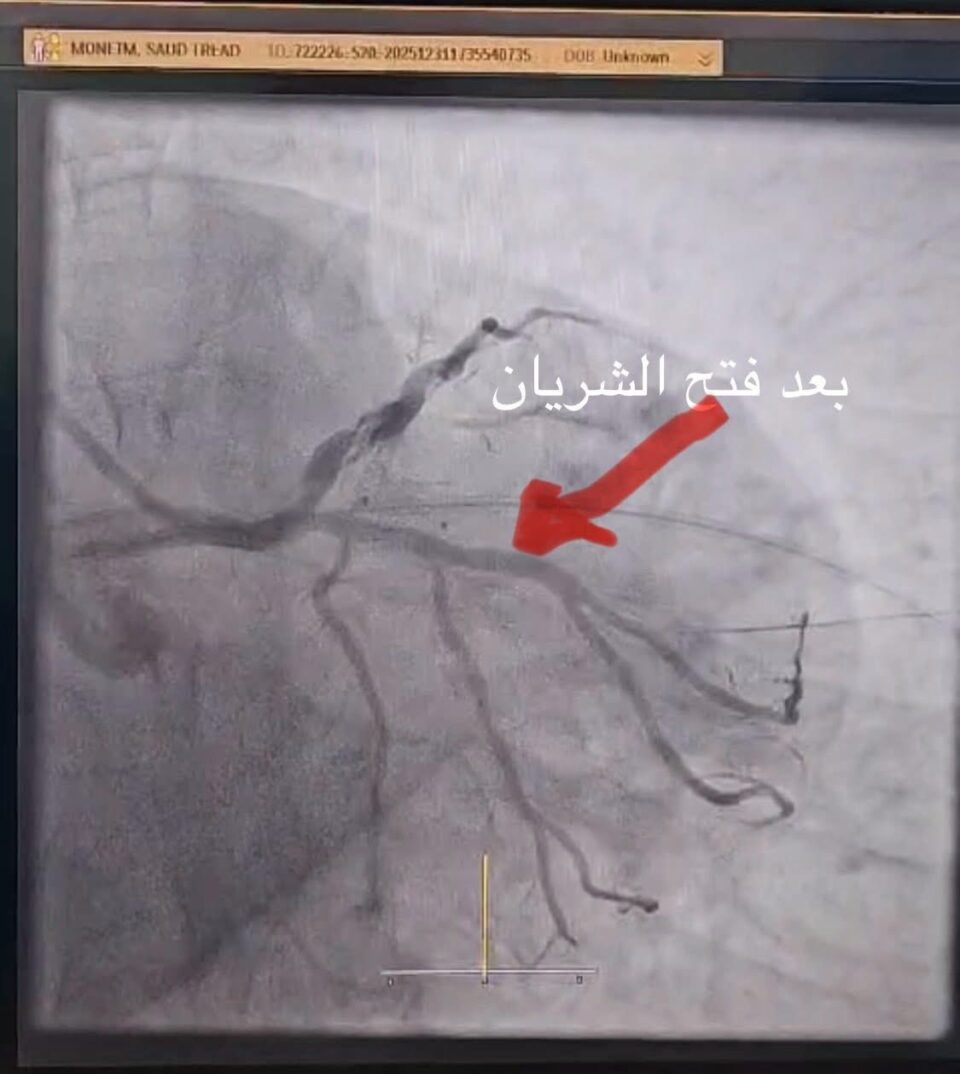 صورة من مقال: مع أولى ساعات 2026… قسطرة قلبية تنقذ ثلاثة مرضى من الموت في الناصرية